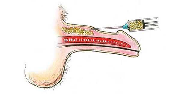 Inyecciones de ácido hialurónico en el cañón de un miembro para aumentarlo